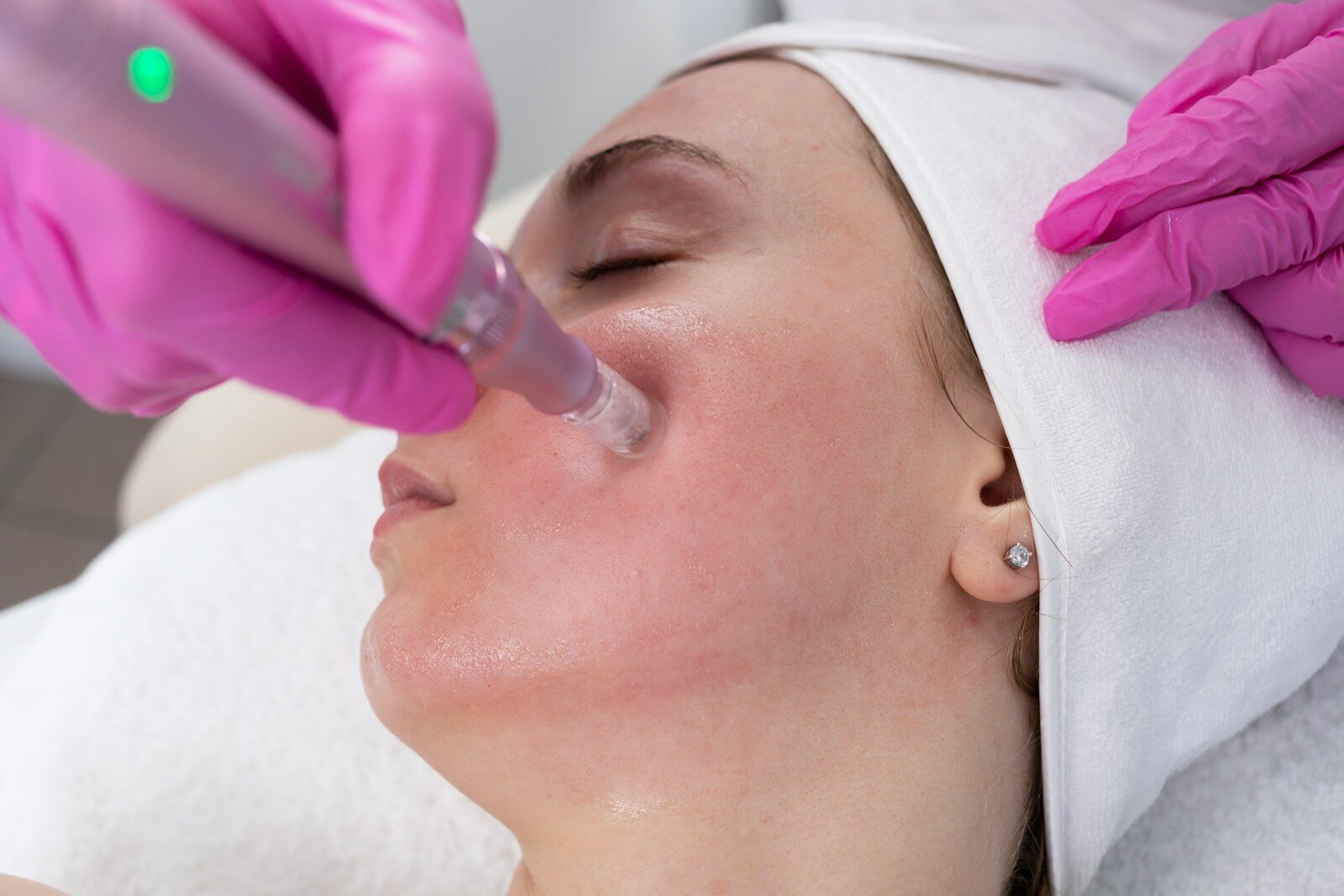 Woman receiving microneedling facial treatment.